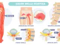 Illustrazione anatomica mostra dove si trova il nervo sciatico e le cause della sciatalgia, come sindrome del piriforme, stenosi spinale ed ernia del disco.