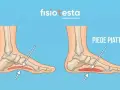 Confronto tra un piede normale e un piede piatto, con frecce che indicano l'arco plantare. Utile per capire gli esercizi per piedi piatti.