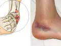 Illustrazione anatomica e foto di un infortunio caviglia con ematoma visibile.