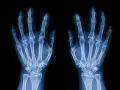 Radiografia delle ossa della mano, mostrando la struttura scheletrica delle dita, del metacarpo e del carpo.