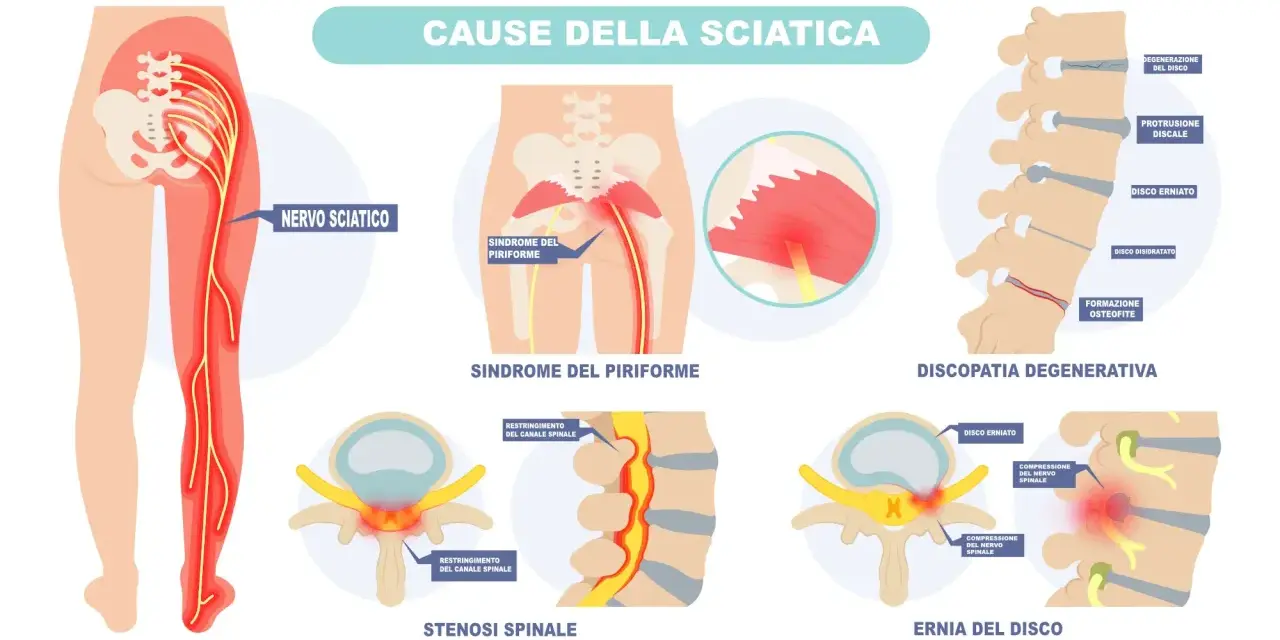 Illustrazione delle cause della sciatica: sindrome del piriforme, discopatia degenerativa, stenosi spinale ed ernia del disco. Capire il dolore al nervo sciatico cosa fare.