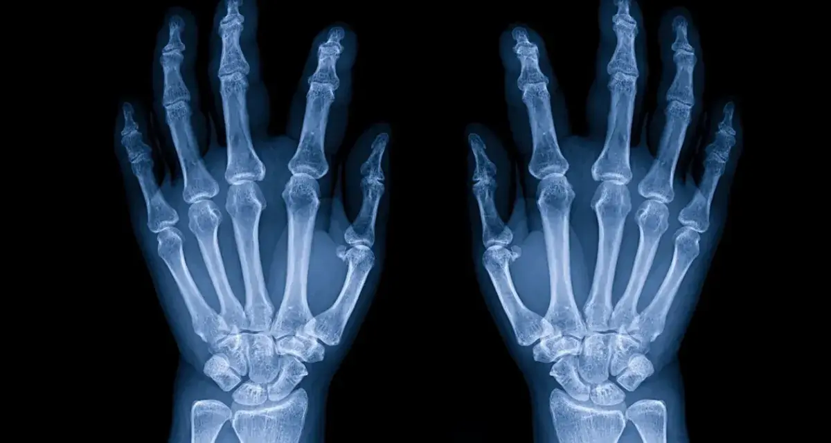 Radiografia delle ossa della mano, mostrando la struttura scheletrica delle dita, del metacarpo e del carpo.
