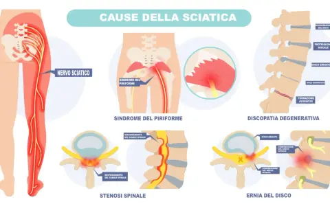 Illustrazione anatomica mostra dove si trova il nervo sciatico e le cause della sciatalgia, come sindrome del piriforme, stenosi spinale ed ernia del disco.