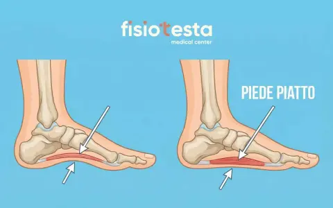Confronto tra un piede normale e un piede piatto, con frecce che indicano l'arco plantare. Utile per capire gli esercizi per piedi piatti.