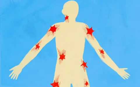 Silhouette umana con punti rossi a forma di stella che indicano aree di dolore, come un trigger point.