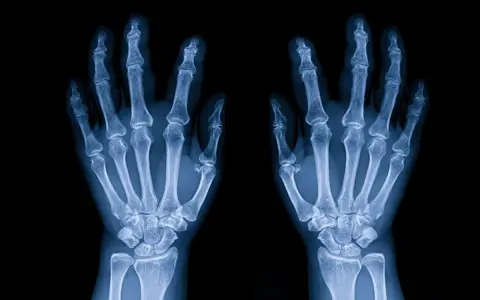 Radiografia delle ossa della mano, mostrando la struttura scheletrica delle dita, del metacarpo e del carpo.