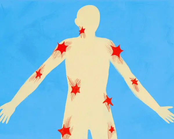 Silhouette umana con punti rossi a forma di stella che indicano aree di dolore, come un trigger point.