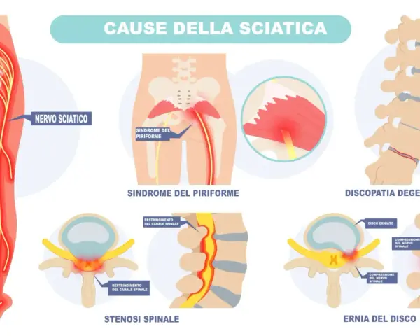 Illustrazione delle cause della sciatica: sindrome del piriforme, discopatia degenerativa, stenosi spinale ed ernia del disco. Capire il dolore al nervo sciatico cosa fare.