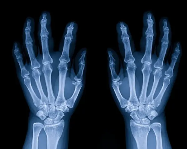 Radiografia delle ossa della mano, mostrando la struttura scheletrica delle dita, del metacarpo e del carpo.