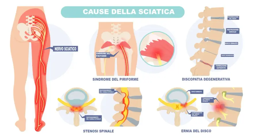 Illustrazione anatomica mostra dove si trova il nervo sciatico e le cause della sciatalgia, come sindrome del piriforme, stenosi spinale ed ernia del disco.