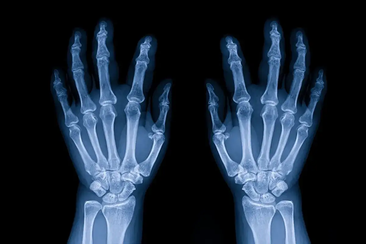 Radiografia delle ossa della mano, mostrando la struttura scheletrica di entrambe le mani su sfondo nero.
