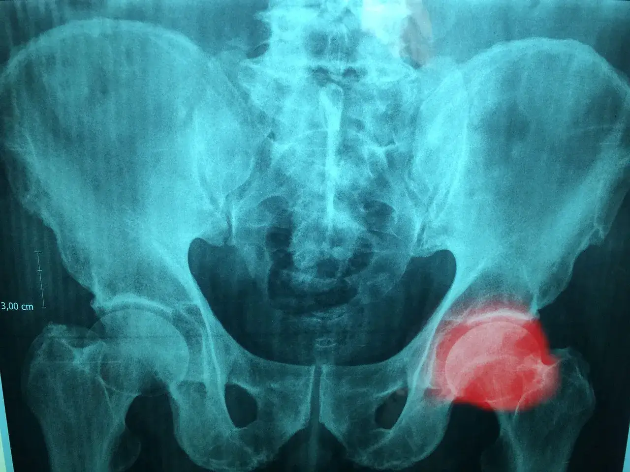 Radiografia del bacino evidenzia l'articolazione dell'anca destra con un'area di sofferenza evidenziata in rosso.